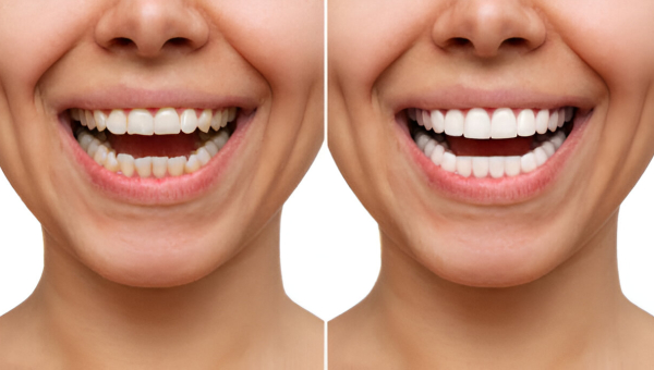 Crowns vs. Veneers in Houston: What Patients Need to Know